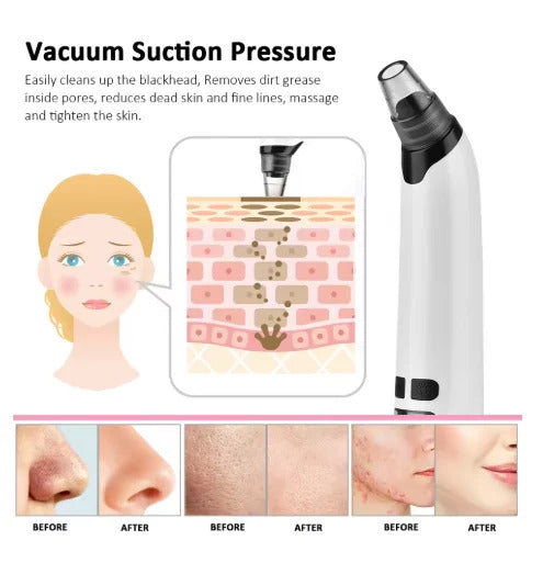 Electric Blackhead Remover – Portable Pore Cleaner-special offer for you